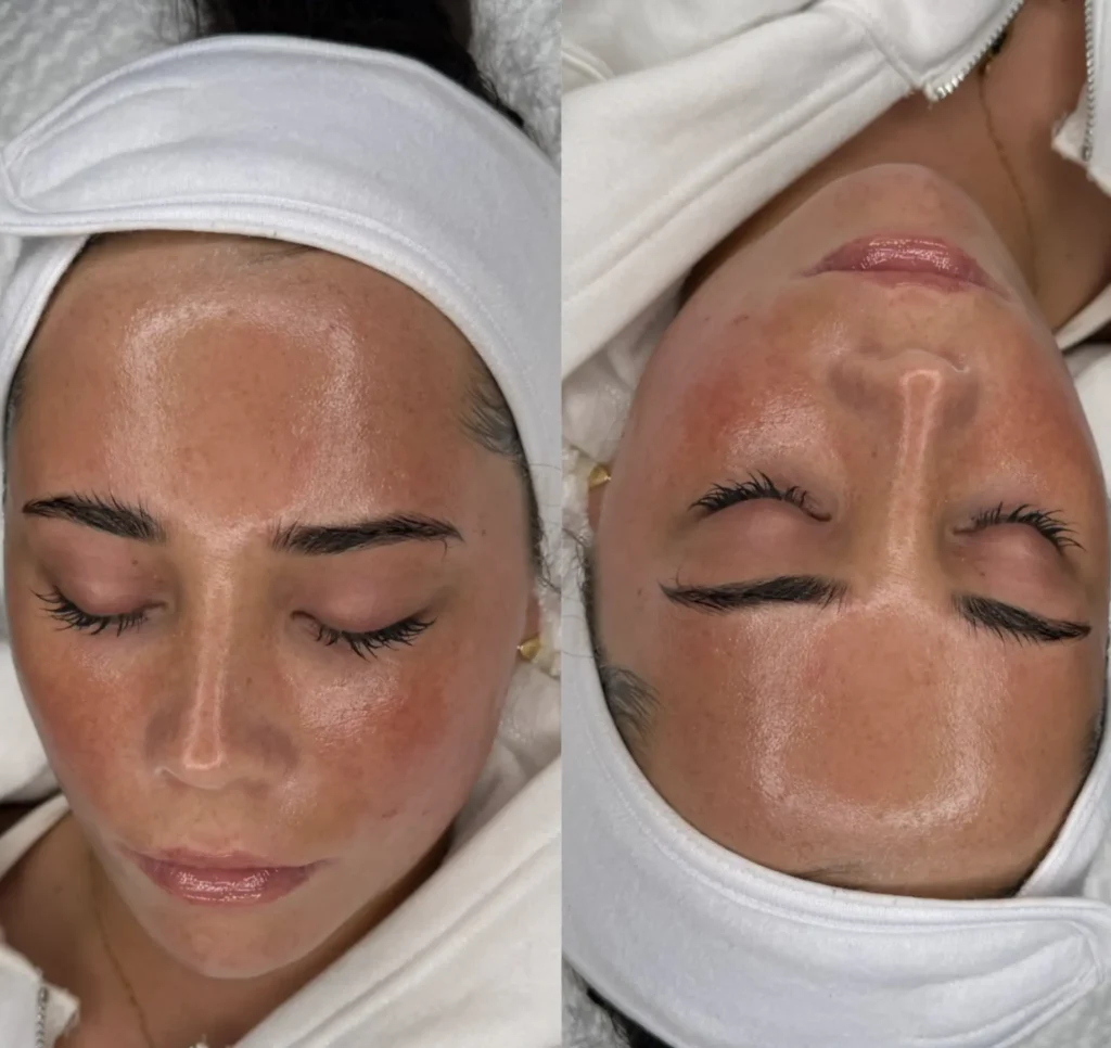 Benefits of Removing Peach Fuzz
