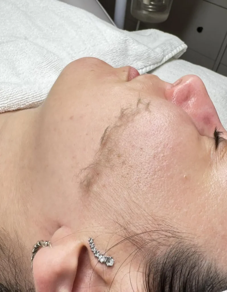 Who Benefits Most from Peach Fuzz Removal