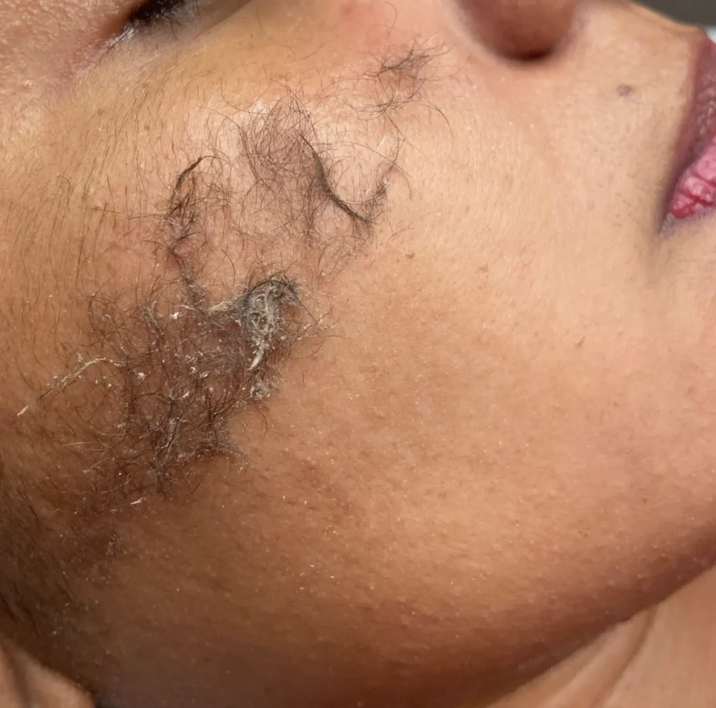 dermaplaning