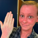 Smiling woman showing her hand with red skin rash for awareness