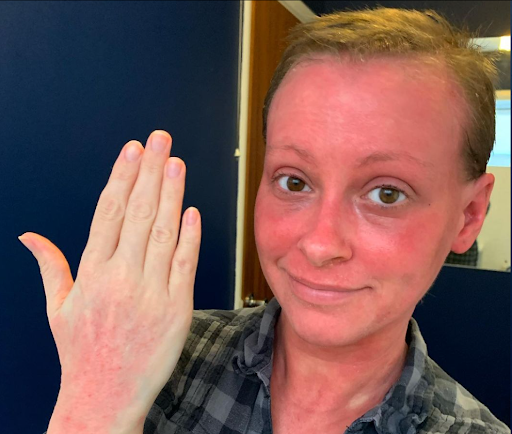 Smiling woman showing her hand with red skin rash for awareness