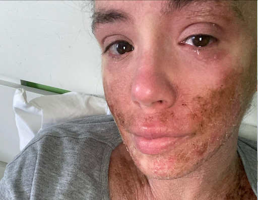 Person with facial skin condition resting in bed